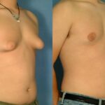 Brystreduksjon er enkel kirurgi